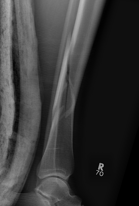 Distal Tibia Intra-articular